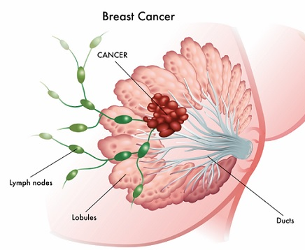 سرطان پستان در بانوان در اثر امواج الکترومغناطیس