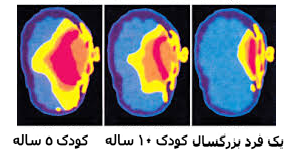 مقایسه اثر امواج الکترومغناطیس بر مغز انسان ها در سنین مختلف